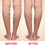 5 Reasons to See a Vein Specialist