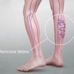 8 Tips for Varicose Vein Pain Relief