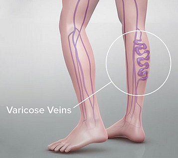 8 Tips for Varicose Vein Pain Relief