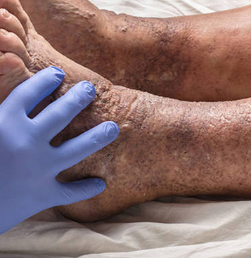 The Main Difference Between Spider and Varicose Veins