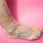 When varicose veins become dangerous?