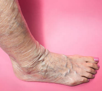 When varicose veins become dangerous?