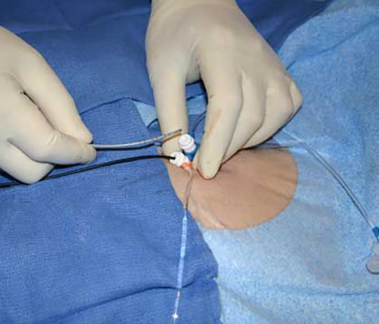 endovenous radiofrequency ablation rfa